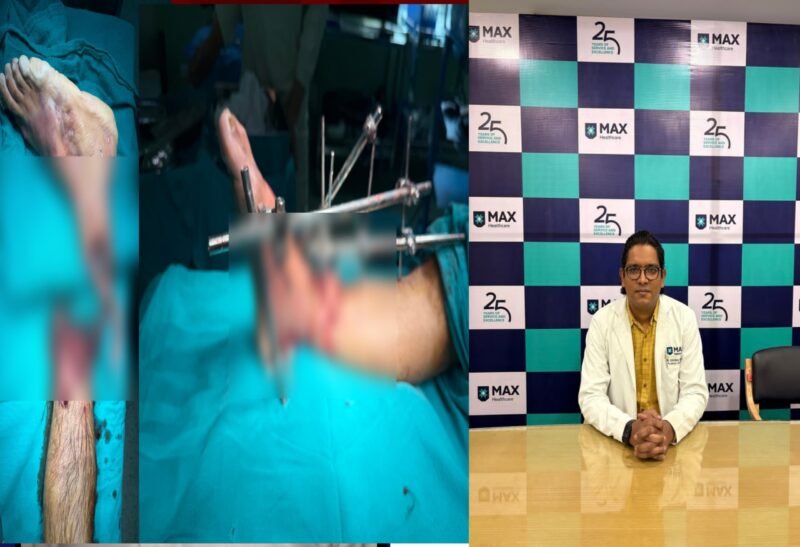 मैक्स हॉस्पिटल, देहरादून ने औद्योगिक हादसे में कटा 23 वर्षीय युवक का पैर सफलतापूर्वक दोबारा जोड़ा